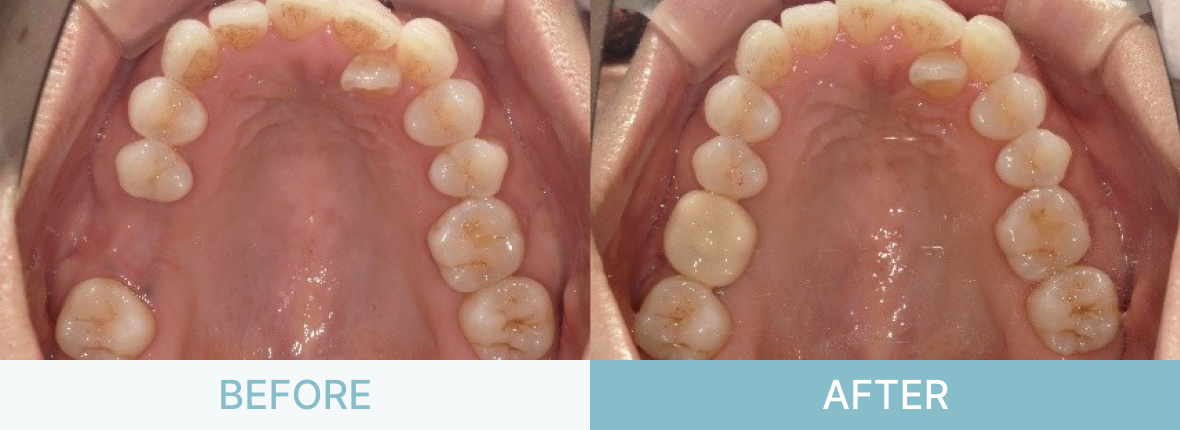 インプラント症例_奥歯に歯を作りたい