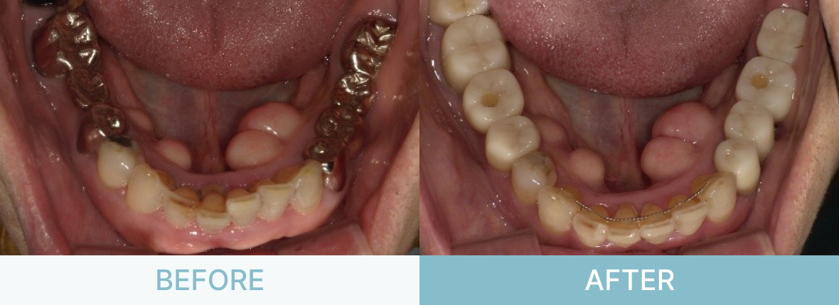インプラント症例_虫歯を治したい