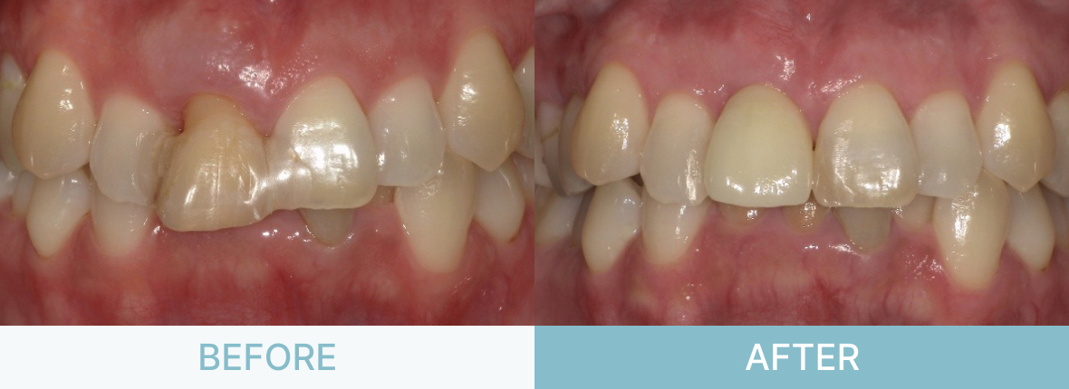 インプラント症例_前歯が腫れて痛い
